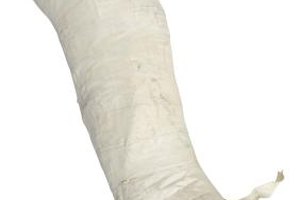 Hemera Technologies/PhotoObjects.net/Getty Images Casting over a period of weeks at an early age can help a baby with clubfoot walk at the proper time.