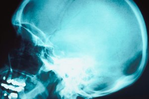 Grandes cantidades de alcohol consumidas durante largos períodos de tiempo pueden conducir a cambios en el cerebro que pueden ser calificados como de daño cerebral.