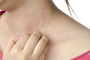 Todo sobre el hongo de las uñas en las manos