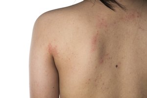Eczema en la piel.