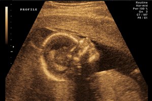El género de un bebé generalmente se descubre con un ultrasonido.