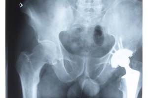 Ciertos ejercicios pueden ayudar a la anteversión femoral.