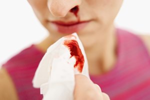El sangrado nasal puede ser signo de presión arterial alta, causada por comer demasiado sodio.
