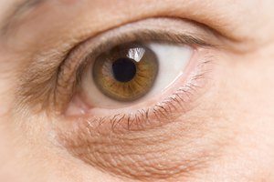 Con el tiempo, las alergias pueden causar ojeras muy oscuras bajo los ojos.