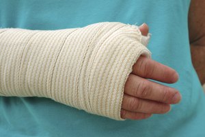 Una fractura de muñeca requiere atención médica.