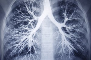Los problemas de ventilación en los pulmones pueden llevar a bajos niveles de oxígeno en la sangre, específicamente si los alvéolos no funcionan correctamente.