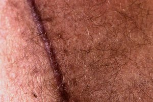 La apariencia de las cicatrices puede reducirse con cremas tópicas.