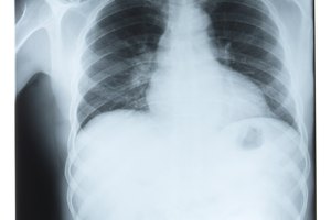 El cáncer de pulmón causa más muertes en el mundo que cualquier otro tipo de cáncer.