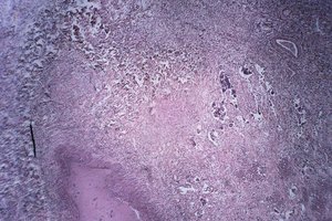 Vista microscópica de células cancerígenas.