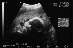 El ultrasonido o ecograma muestra el estado del bebé y su posición antes de nacer.