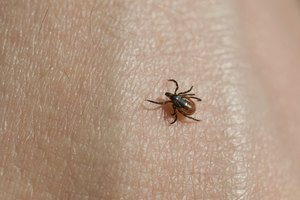 No todas las garrapatas y no todas las picaduras de garrapatas transmiten la enfermedad de Lyme.