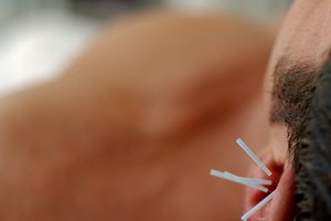 Un estudio dice que la acupuntura de la oreja puede promover la pérdida de peso.