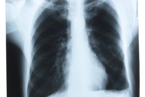 La destrucción alveolar es el sello del enfisema.