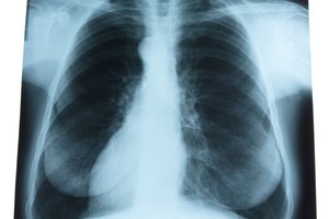 Las crepitaciones pulmonares suelen ocurrir debido a una obstrucción.