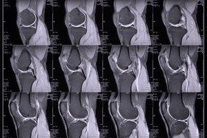 La página web TheraPilates recomienda que los pacientes con osteoporosis se escaneen la densidad ósea cada dos años.
