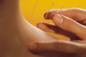 La acupuntura te hará sentir mejor del cuello y reducirá tu estrés.