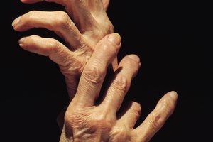 El gel de árnica puede ayudar a aliviar el dolor de la artritis en las manos.