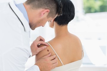 Dermatologist looking at patient's mole Dermatologist looking at patient's mole