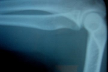 Orthopedics is one field in which chiropractors can find a niche. Orthopedics is one field in which chiropractors can find a niche.