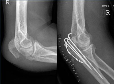 What Are the Causes of Pain in the Arm?