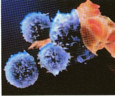 What Happens When HIV/AIDS Is Left Untreated?