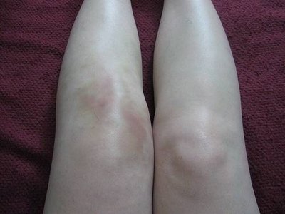 Fluid on the left knee