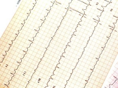 heart rhythm