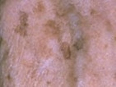 What Are the Causes of Liver Spots?
