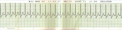 Supraventricular Tachycardia