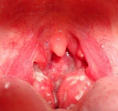 Swollen Tonsils in Children