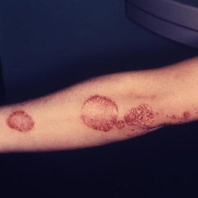 Psoriasis is characterized by scaly skin over the affected areas