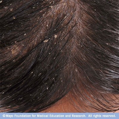 Seborrhoeic Dermatitis looks like dandruff, but can cause a more serious rash or scaling of the skin