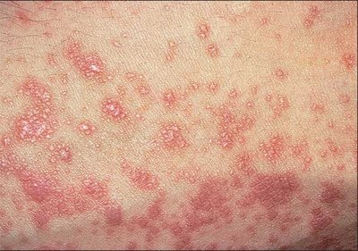 Lichen planus is characterized by what looks like red, mucus-filled bumps on the scalp