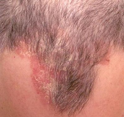 Scalp acne is caused by the build-up of dirt and bacteria under the hair