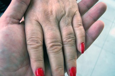 Dupuytren's Disease may also cause thickening on top of the knuckles.