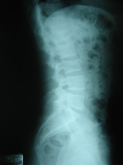 Most bulging discs occur in the lumbar spine.