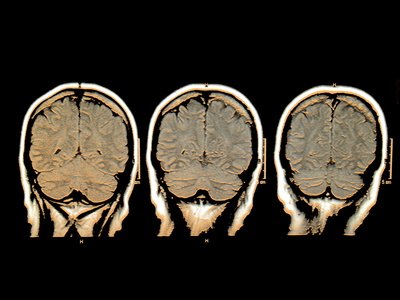 Memory foods not only help maintain brain function, but also prevent memory loss.
