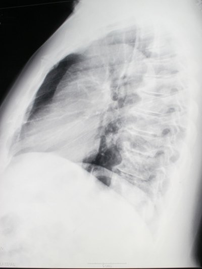 An MRI will reveal no tear in the annulus of a bulging disc.