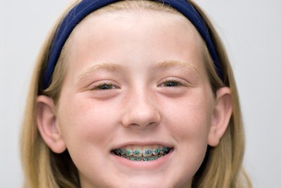 Avoid certain drinks while wearing braces.
