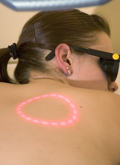 To get maximum results, undergo a series of five treatments of IPL over a three-week time period.