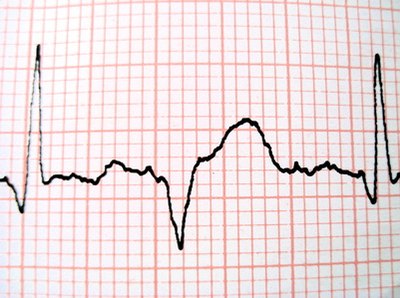 EKG tests provide additional data about heart functions.