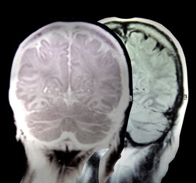 Untreated hypertension can damage the brain and other organs