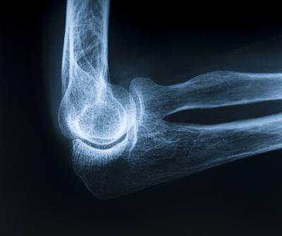Ewing's sarcoma affects the shaft or middle part of large bones in the upper arm.