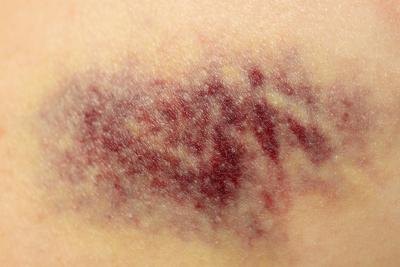 Rub the gel on bruise.