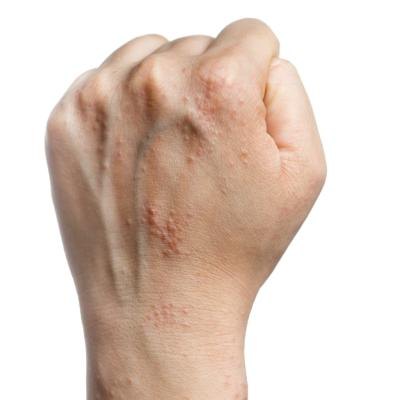 Inflamed skin from bug bites.