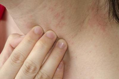 Scientists first discovered the human itch mite in the 17th century.