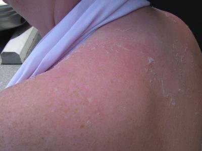 Avoiding sunburn is one step in melanoma prevention.