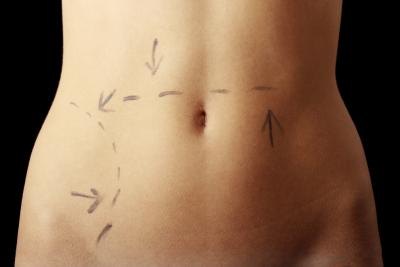 A tummy tuck, tightens and flattens the abdominal area.
