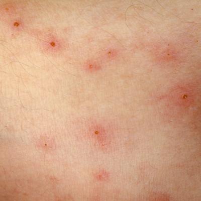 Allergic reactions to bug bites can cause raised bumps on the skin.