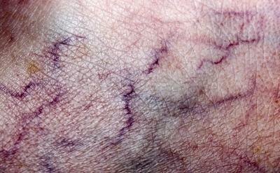 Varicose veins cause blood to pool.